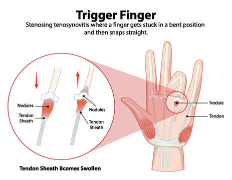 Diagram explaining trigger finger condition and symptoms