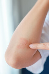 Close-up of skin Asian woman with acute psoriasis on her elbows. autoimmune incurable dermatological skin disease. A large red, inflamed, flaky rash on the elbows. skin by psoriatic arthritis.