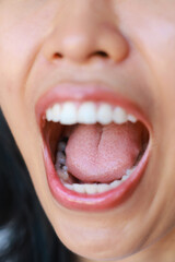 Close-up of tooth decay young Asia woman, So we should be care dental with the hygiene. Oral health...