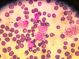 Chronic myeloid leukemia cells or CML, analyze by microscope. Blood cancer image.