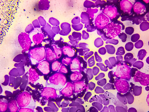 Acute lymphoblastic leukemia (ALL), Mature B-cell analysed by light microscope. Which is known as Burkitt leukemia. Close up micrograph.