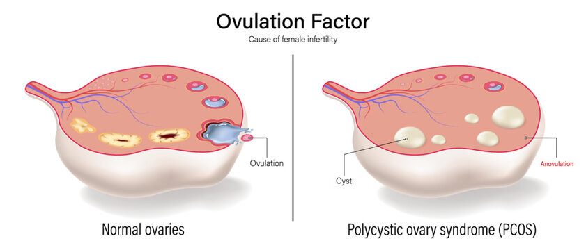 Female infertility vector. Comparison of normal ovaries and polycystic ovary syndrome (PCOS). Ovulation factor. Female reproductive system.