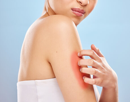 Skin, scratch and woman in studio with rash on arm for virus or bacteria infection and eczema. Model girl, touch and red anatomy for food allergies with skincare problem or lupus by blue background