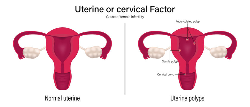 Female infertility vector. Comparison of normal uterine and uterine polyps. Uterine factor. Pedunculated, Sessile and Cervical polyp.