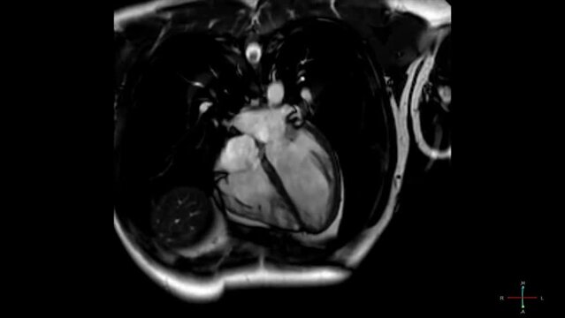 MRI Scan of beating heart, magnetic Resonance Imaging or X-ray to diagnosis cardiac disease. Cardiology, Science, Healthcare and medical concept. Seamless looping.