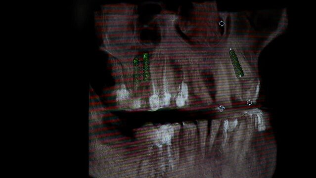 CT scan concept: Video of the x-ray overview of an orthodontic tooth implant. Axial Computed Tomography, 
