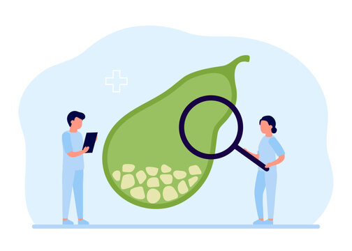 Doctor treat gallbladder sick with stones. Cholecystitis, gallstone disease. Gastroenterologist scientist examine gall bladder with magnifying glass. Vector flat illustration