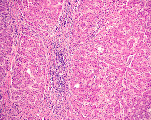 Human liver. Cirrhosis