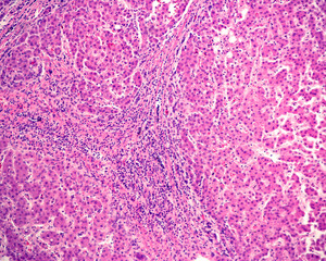 Human liver. Cirrhosis