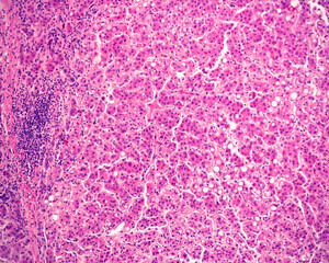 Human liver. Cirrhosis
