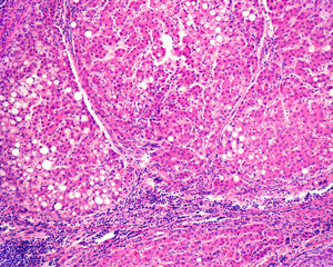 Human liver. Cirrhosis