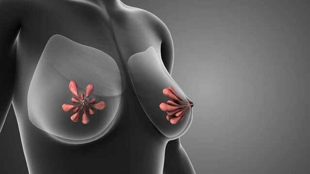 Mastopexy or breast lift surgery
