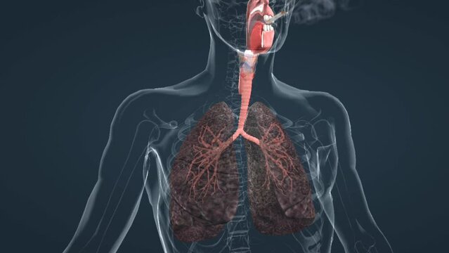 COPD and chronic bronchitis