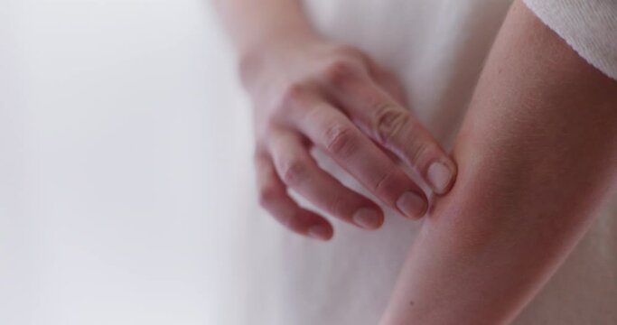 Close-Up of Red Swelling After a Wasp Sting on a Woman's Forearm