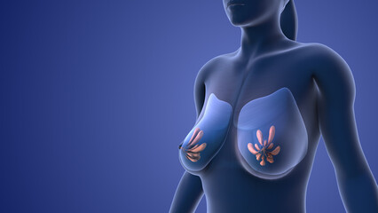 Mastopexy or the procedure of breast lifting