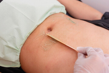 Applying Ultrasound Conductive Gel on abdomen for radiofrequency, cavitation, microcurrent, ultrasound and other treatments.