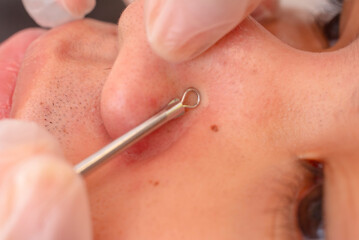An esthetician uses a comedone extractor to remove blackheads on the nose of a male patient. Closeup shot of a facial procedure and treatment at a dermatology or aesthetic clinic.