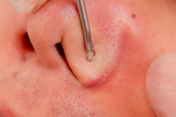 Fototapeta premium An esthetician uses a comedone extractor to remove blackheads on the nose of a male patient. Closeup shot of a facial procedure and treatment at a dermatology or aesthetic clinic.