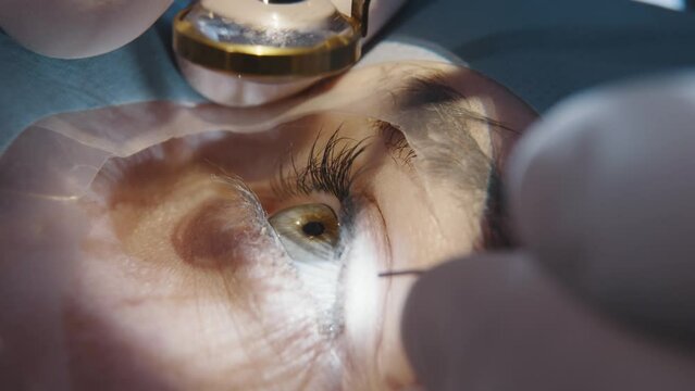 A doctor uses a microscope during eye surgery or diagnosis, cataract treatment and diopter correction. A surgeon looks through a microscope at a patient's eyes in the operating room.