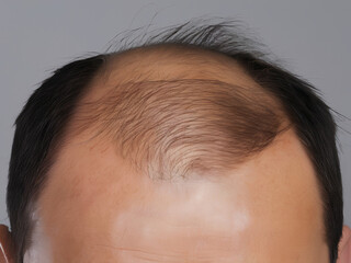 Receding Hairline 