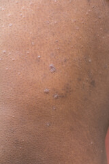 Fototapeta premium Eczema on brown skin, atopic dermatitis and prurigo nodularis on brown skin leg, eczema breakout on dark skin