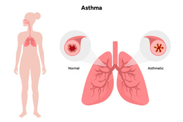 Human asthma asthmatic airway