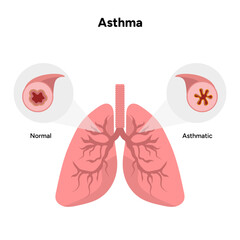 Human's lungs asthma asthmatic and normal airway