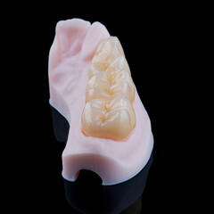 High-quality naturally dental single crowns made of zirconium for fixation to the frontal teeth of upper jaw. © gorynvd