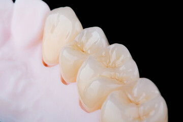 High-quality naturally dental single crowns made of zirconium for fixation to the frontal teeth of upper jaw. © gorynvd