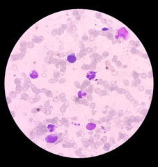 Bone marrow study(BMS): Lymphocytosis with clumped chromatin. Pancytopenia in PBF....