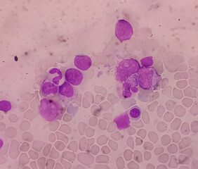 Bone marrow study(BMS): Lymphocytosis with clumped chromatin. Pancytopenia in PBF. Lymphoproliferative disorders. Lymphoproliferative disease.