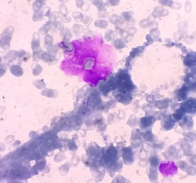 Bone marrow study(BMS): Lymphocytosis with clumped chromatin. Pancytopenia in PBF. Lymphoproliferative disorders. Lymphoproliferative disease.