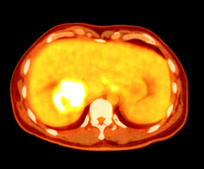A PET CT scan reveals cholangiocarcinoma with suspected metastatic involvement of the lungs and lymph nodes.