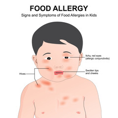Food allergy signs and symptoms in kids