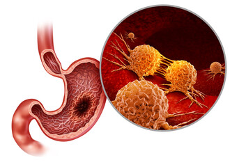 Human Stomach Cancer and Gastric tumor in the digestive system as a medical and gastrointestinal disease with painful belly symptoms as a medicine concept.