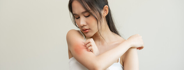 Dermatology, asian young woman reaction from atopic, insect bites on her arm, hand in scratching itchy red spot or rash of skin. Healthcare, treatment of beauty. © Pormezz