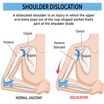 Shoulder dislocation and humerus bone trauma explanation outline diagram. Painful arm vs healthy. Labeled educational medical injury when skeletal part rotates out of scapula vector illustration.