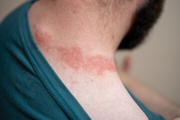 Fototapeta premium young man with skin spots around the neck. illness, diseases, allergies, psoriasis, eczema, dermatitis