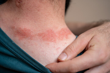 Fototapeta premium young man with skin spots around the neck. illness, diseases, allergies, psoriasis, eczema, dermatitis