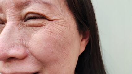 close up the Flabby skin and wrinkle beside the eyelid, swelling and ptosis, dark spots and blemish on the face of middle aged women, health care and beauty concept.