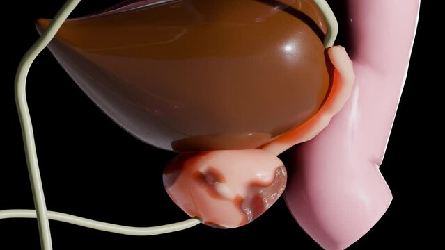 Prostate cancer stages. ancerous cells, malignant tumor compresses urethra. Pathological disruption, genital reproductive system anatomy, bladder Oncological or Urological Disease, bph, 3d render