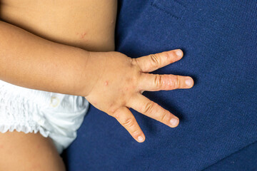 Close-up of a child's hand infected with hand-foot-mouth disease or HFMD originating from...