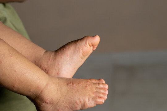 Close-up of a child's feet infected with hand-foot-mouth disease or HFMD originating from enterovirus or coxsackie virus, copy space on the right