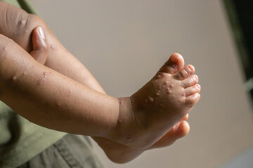 Close-up of a child's feet infected with hand-foot-mouth disease or HFMD originating from...