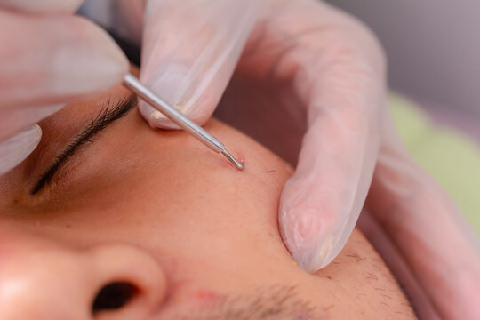 Closeup shot - Using the hook end of a comedone extractor to pierce a blackhead.
