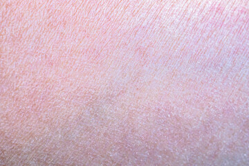 dry and dehydrated human skin texture background