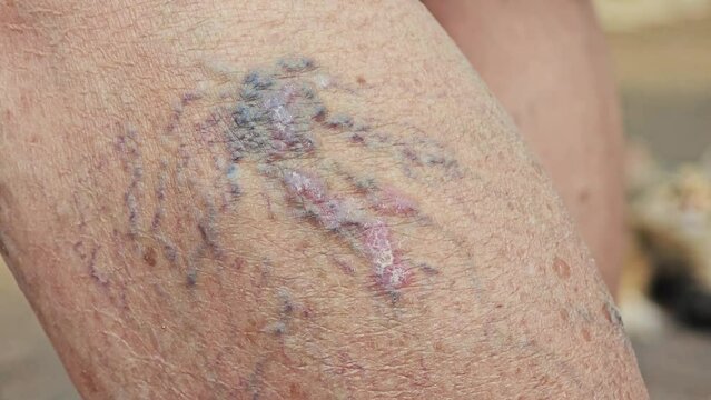 Skin of a woman with thrombosis