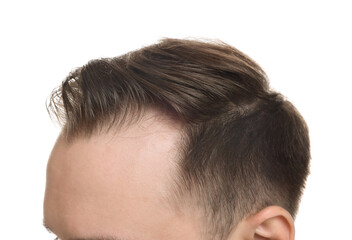 Obraz premium Baldness concept. Man with receding hairline on white background, closeup