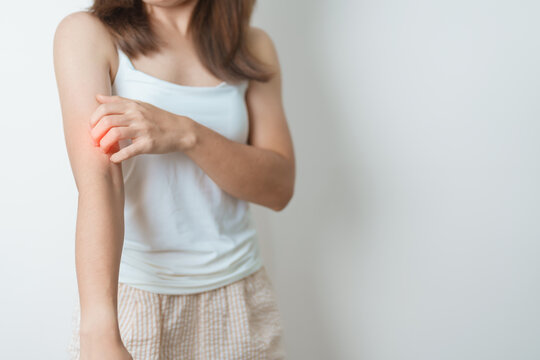 woman itching and scratching itchy arm. Sensitive Skin Allergic reaction to insect bite, food, drug dermatitis. Dermatology, Leprosy day, Systemic lupus erythematosus, Allergy symptoms and rash Eczema