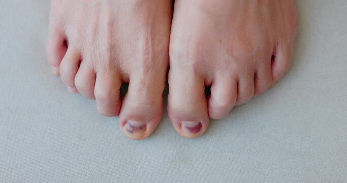 Subungual Hematoma on toenail are injuries of wearing shoes that are too tight in which bleeding develops under the nail. Crush injury to the distal phalanx fingernail or toenail, black toenail. 4k.